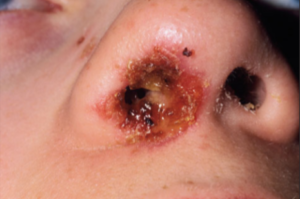 nasal vestibulitis