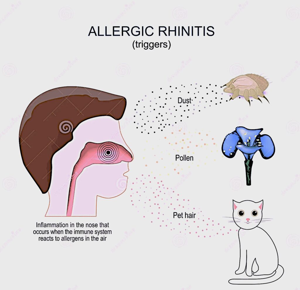 allergic rhinitis allergic rhinitis symptoms allergic rhinitis treatment allergic rhinitis causes allergic rhinitis in children allergic rhinitis vs common cold seasonal allergic rhinitis perennial allergic rhinitis hay fever (allergic rhinitis) chronic allergic rhinitis