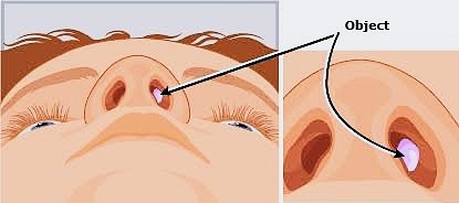 Something is Stuck in nose . dr monika barkhane